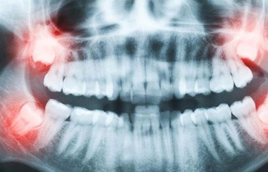 علت رشد دندان عقل,دندان عقل,دانستنی های پزشکی