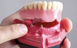 عوارض دندان مصنوعی بیشتر است یا اوردنچر؟ عوارض دندان مصنوعی بیشتر است یا اوردنچر؟