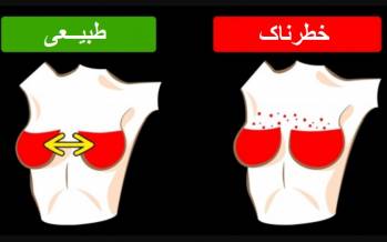 کدام تغییرات پستان ها طبیعی و کدام خطرناک هستند؟ شانه های سرطان سینه,تغییرات در پستان ها طبیعی,دانستنی های پزشکی