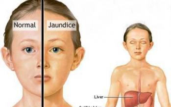 علل ، علائم و درمان سندرم ژیلبرت medical