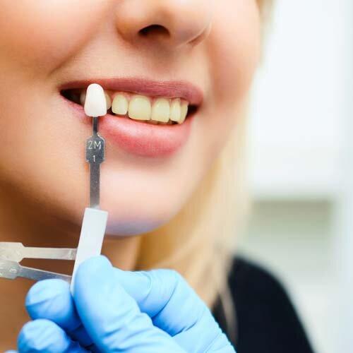 درمان کامپوزیت برای زرد شدن دندان